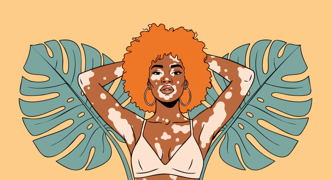 Beautiful Black Woman with Vitiligo and Orange Afro Hair in Bra Top, Posing with Tropical Monstera Leaves on a Yellow Background Vector Illustration