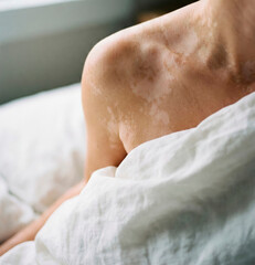 Person with vitiligo showing shoulder, symbolizing inclusivity, self-acceptance, natural beauty for health blogs, dermatology, wellness, and body positive campaigns