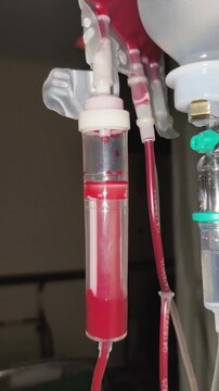 El Goteo de la Vida: Bolsa de Sangre en Transfusi&oacute;n M&eacute;dica