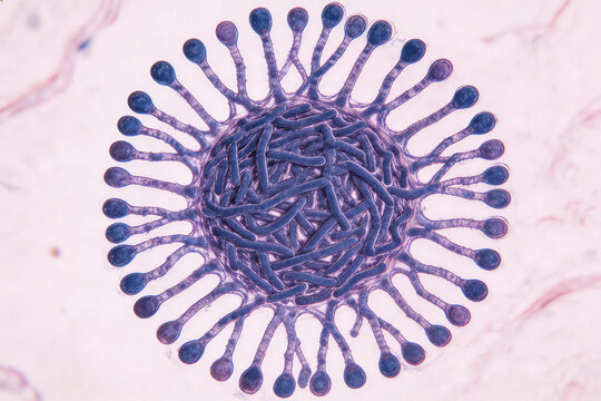 Micrograph of Actinomyces israelii, filamentous branching gram-positive rods forming sulfur granule with radiating clubs at periphery