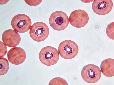 Red blood cells infected with Plasmodium (the malaria parasite). The Plasmodium appears as a purple ring within the pink red blood cell, a characteristic feature of Giemsa staining.