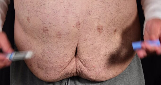 Close up of male body with saggy belly skin during a GLP-1 injection process for weight management and diabetes medical treatment.