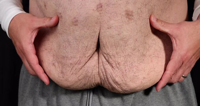 Close up of a man's abdomen showing extreme loose skin after significant weight loss using Semaglutide GLP-1 medical injection pens.