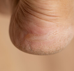 Fototapeta premium A person's foot with a callus