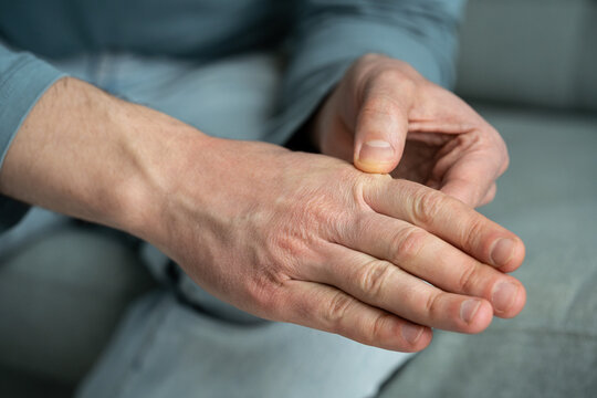 Man showing dry skin on hand and fingers with redness cracks and chapping. Male with aging skin on hands, dryness caused by dehydration, health problems and dry air at home during heating season.