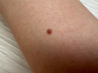Fototapeta premium Brown nevus on the skin of a human arm. Close up view of a mole on the body. Medical dermatology concept for mole check, skin cancer screening and health examination of epidermis.