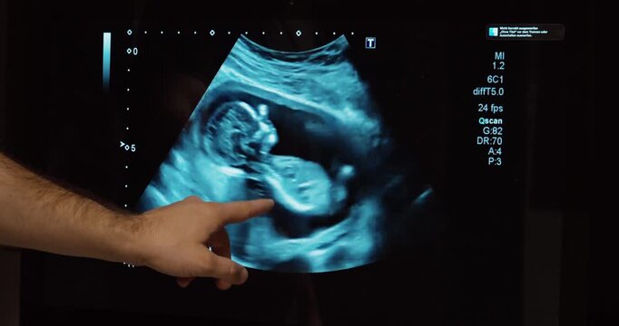 Close-up of a pregnancy ultrasound scan showing a baby in the womb while a hand points to the monitor. Concept of prenatal care, medical examination, pregnancy monitoring, and fetal development.