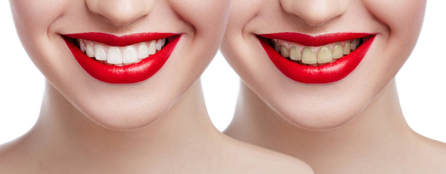 Teeth whitening before after. Woman Teeth Before and After Whitening. Happy smiling woman face close up. Dental health Concept. Oral Care concept