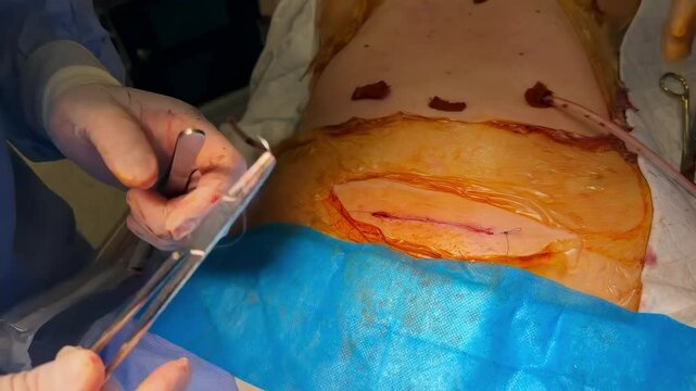 Surgeon continues stitching incision drawing needle through skin. Hands tie firm knot trimming thread to finish wound closure step cleanly