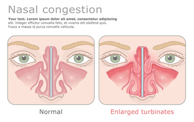 Fototapeta premium Anatomical comparison of normal nasal cavity and hypertrophied nasal turbinates. Vector illustration. ENT Series.