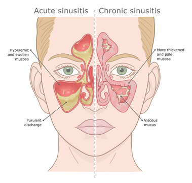 Medical illustration comparing acute and chronic sinusitis symptoms in a female face. Vector illustration. ENT Series.