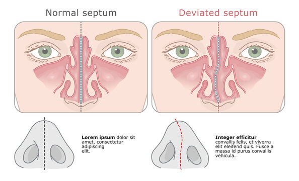 Anatomical comparison of a straight and deviated nasal septum in human nose. Vector illustration. ENT Series.