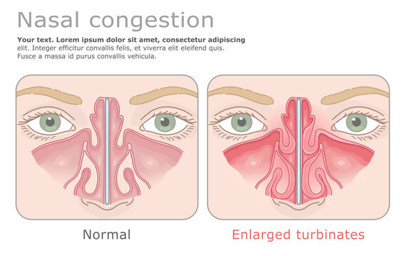 Anatomical comparison of normal nasal cavity and hypertrophied nasal turbinates. Vector illustration. ENT Series.