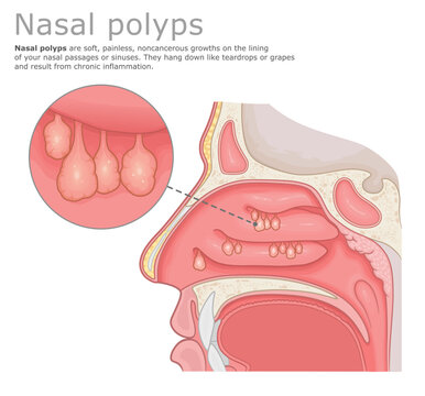 Anatomical diagram of nasal polyps with close-up view of growths in the nose. Vector illustration. ENT Series.