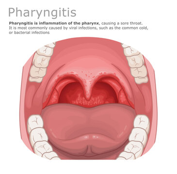 Medical vector illustration of pharyngitis, showing an open mouth with an inflamed and reddened throat. ENT Series.
