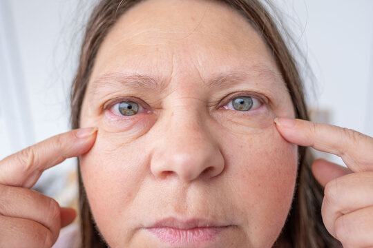 female eye with visible redness, severe swelling, Clinical observation periorbital edema, inflammatory process, allergic or infectious eye condition, ocular inflammation and trauma, blepharitis