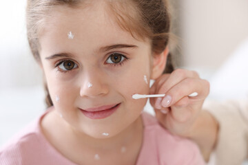 Mother applying cream onto skin of her daughter with chickenpox at home, closeup