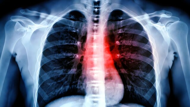 Chest x-ray of human torso showing glowing heart and lungs. Cardiology and respiratory health diagnosis. Medical scan of rib cage highlighting internal organs for disease detection