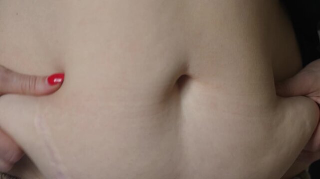 Close-up of a woman squeezing a fat fold on her belly with both hands. Video demonstrating the problem of cellulite, excess weight, and postpartum stretch marks