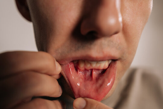 Close-up of male individual gently pulling down lower lip, showcasing visible canker sore on inner mouth lining, representing symptoms of stomatitis, oral infection, and the need for health care