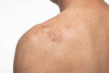Fototapeta premium High-resolution 8K macro close-up image showcasing sun-damaged skin with actinic keratosis-like rough patches and fine freckles on an upper back and shoulder area, captured with professional lighting