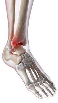 3D medical illustration of a human ankle, focusing on malleolar fractures of the distal tibia and fibula. Skeletal structure with red highlights and translucent soft tissues on white.