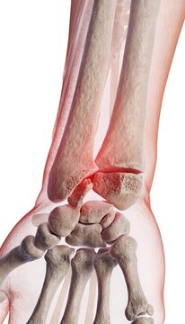 3D medical illustration of a human wrist with a distal radius and scaphoid fracture. Skeletal structure with red injury highlights and translucent soft tissue on a white background.