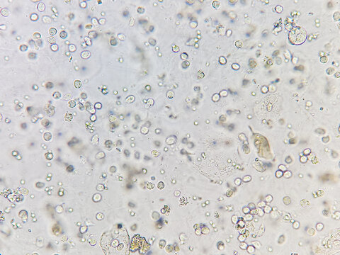 Calcium oxalate monohydrate, pus cells in urine under microscope.