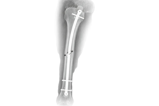 X-ray of human femur leg showing internal fixation rod and screws orthopedic bone fracture repair medical surgical treatment isolated on white background
