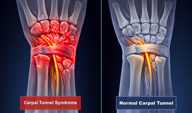 Carpal tunnel syndrome vs normal anatomy 