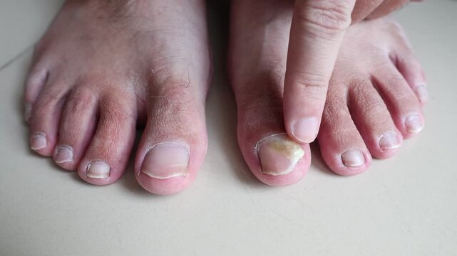 Close up of a man touching a damaged toenail with onychomycosis. Male finger pointing at a yellow unhealthy nail on a foot. Concept of dermatology, podiatry, nail dystrophy and fungal infection.