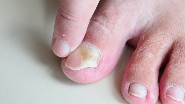 Close up of a man touching a damaged toenail with onychomycosis. Male finger pointing at a yellow unhealthy nail on a foot. Concept of dermatology, podiatry, nail dystrophy and fungal infection.