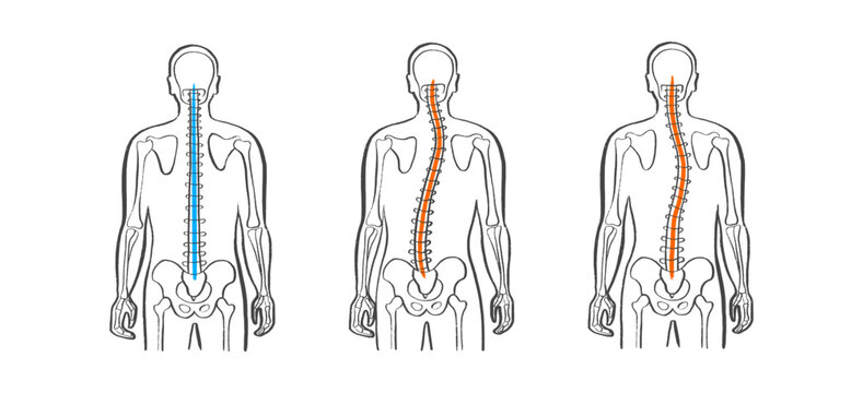 Scoliosis spine deformity