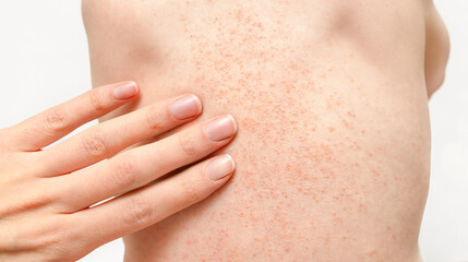 a woman's hand touches a child's back, which has a rash