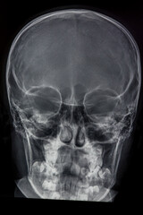 An X-ray image of a human skull, providing a clear view of the bone structure. U  © Mario