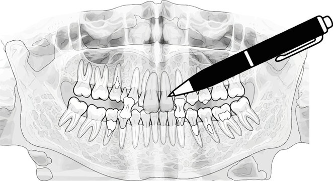 Stylized dental X-ray with pen pointing to a tooth