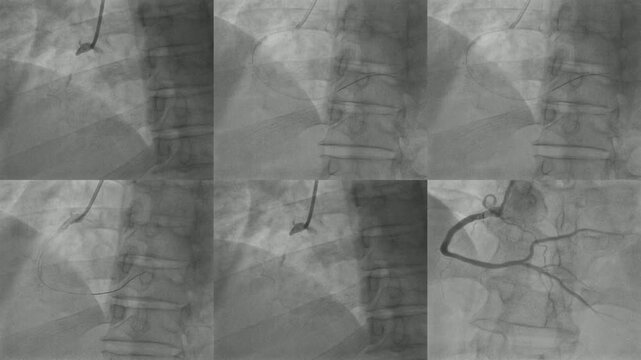 Cardiac Catheterization Coronary Angiography of Human Heart Arteries