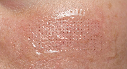 Fototapeta premium Macro view of skin surface with micro-punctures and redness following professional microneedling or fractional laser treatment for collagen induction.
