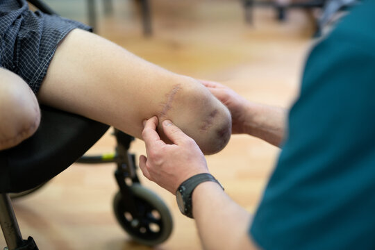 Physical therapist examining a Ukrainian veteran's amputated leg in a clinic