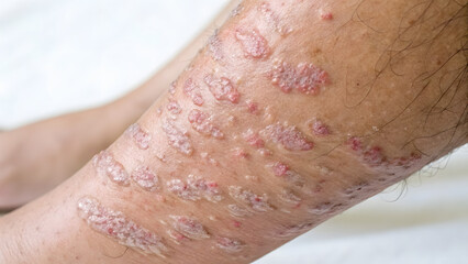 Fototapeta premium Close up view of human calf skin affected by psoriasis
