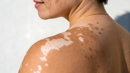 Fototapeta premium Close up of human shoulder skin showing vitiligo patches