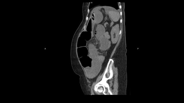 Multiplanar CT scan of the abdomen demonstrating sagittal, coronal, and axial reconstructions revealing ascites in the perihepatic and perisplenic spaces with minimal bilateral pleural effusion