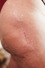 Naklejka premium Close-up photo of a surgical scar on the leg in the hip area after hip replacement surgery. Medical concept of orthopedic operation, joint replacement, postoperative recovery, rehabilitation, and heal