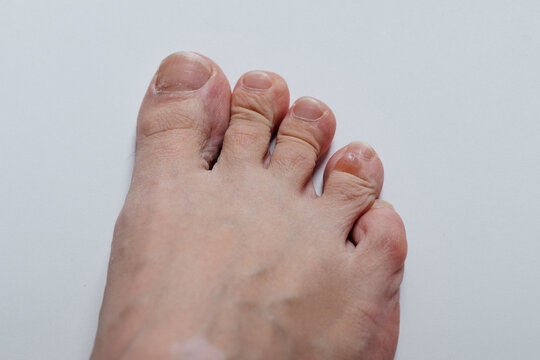 Serous blister on little toe foot closeup