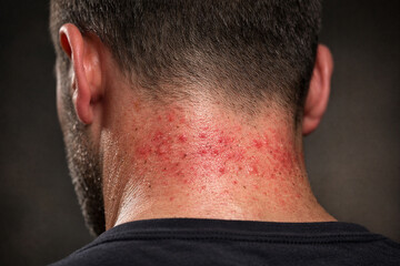 Naklejka premium A man with a red rash on the back of his neck