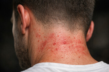 Naklejka premium A man with a red rash on the back of his neck