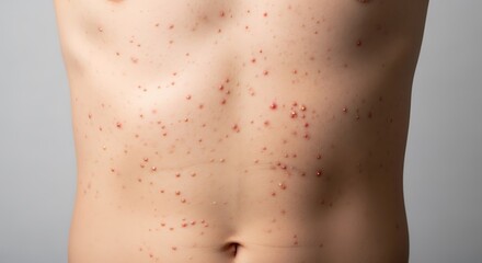 A close-up view of a human torso covered in a rash with multiple red bumps and small skin lesions