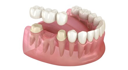 Obraz premium Prosthetic Dentistry Bridge on Upper Jaw Demonstration