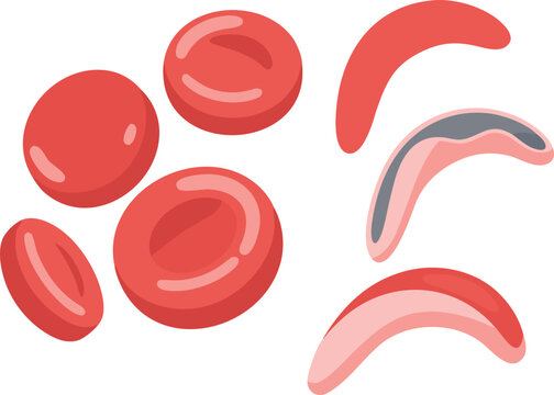 Illustration comparing normal round red blood cells with deformed sickle-shaped ones, representing sickle cell anemia, hemoglobinopathy, vaso-occlusion, and chronic hemolytic disorder