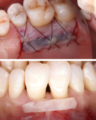 Obraz premium Soft tissue graft for jawbone resorption and gum recession in dentistry. Periodontal treatment involving dental grafts and gingival transplantation. dental treatment gum and implant